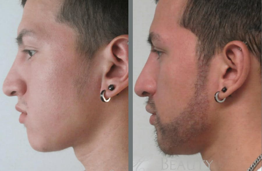 Hair Transplant Before & After Gallery - Patient 54187637 - Image 1