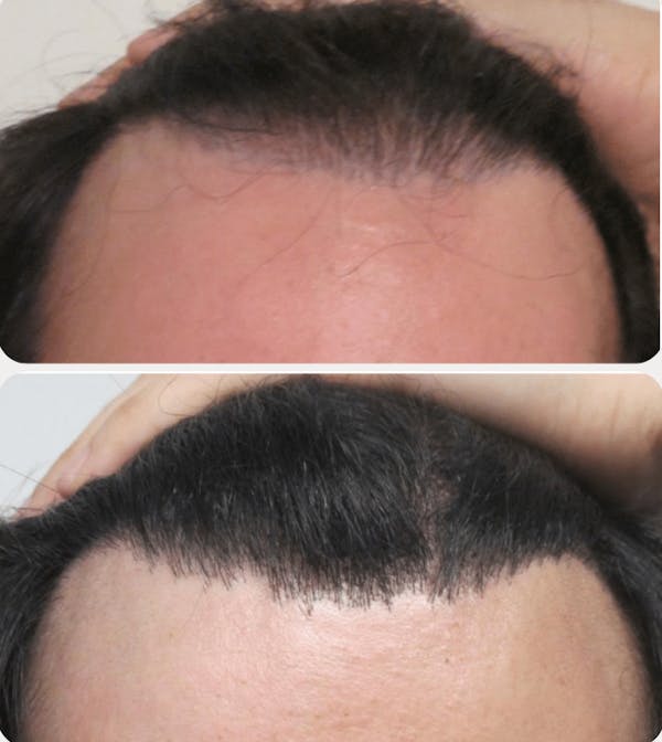 Hair Transplant Before & After Gallery - Patient 54187638 - Image 1
