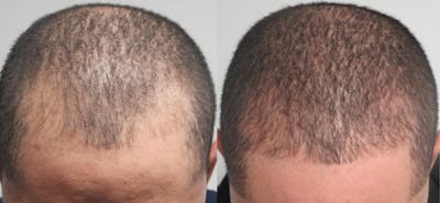 Hair Transplant Before & After Gallery - Patient 54187639 - Image 1