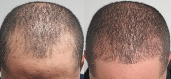 Hair Transplant Gallery - Patient 54187639 - Image 1