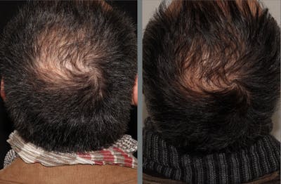 Hair Transplant Gallery - Patient 54187640 - Image 1