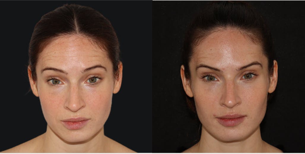 Before Before and After Botox in NYC