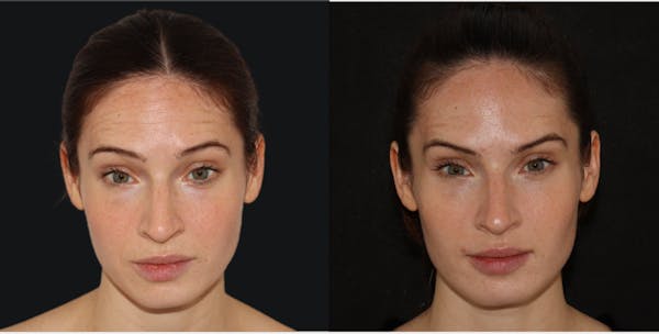 Botox Before & After Gallery - Patient 141186481 - Image 1