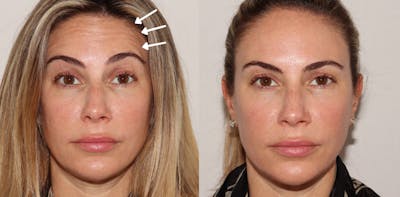 Botox Before & After Gallery - Patient 141186456 - Image 1