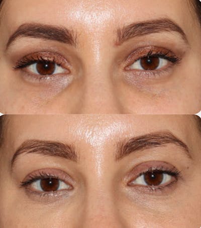 Under Eye Filler Before & After Gallery - Patient 141186398 - Image 1