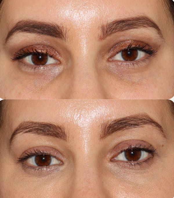 Eye Filler Before & After Gallery - Patient 141186398 - Image 1