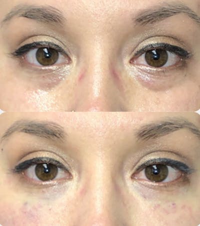Under Eye Filler Before & After Gallery - Patient 141186400 - Image 1