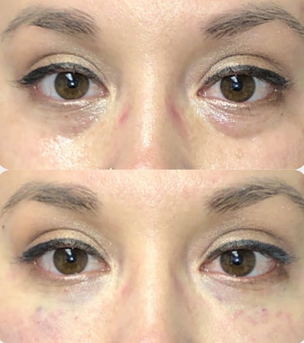 Eye Filler Before & After Gallery - Patient 141186400 - Image 1
