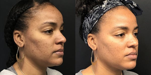 Laser Resurfacing Before & After Gallery - Patient 54187941 - Image 1
