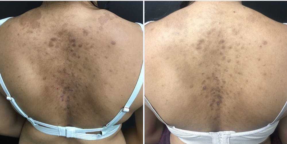 Laser Resurfacing Before & After Gallery - Patient 54187942 - Image 1