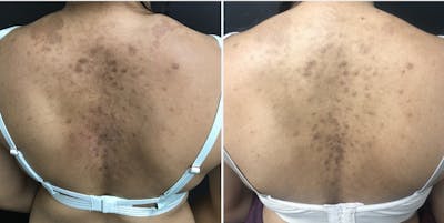 Laser Resurfacing Before & After Gallery - Patient 54187942 - Image 1