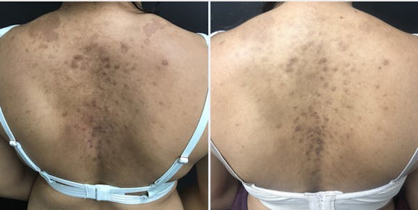 Laser Resurfacing Before & After Gallery - Patient 54187942 - Image 1