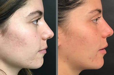 Laser Resurfacing Before & After Gallery - Patient 54187943 - Image 1