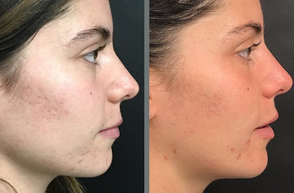 Laser Resurfacing Before & After Gallery - Patient 54187943 - Image 1