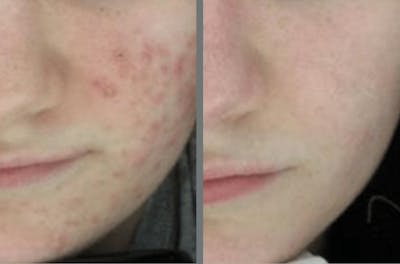 Laser Resurfacing Before & After Gallery - Patient 54187944 - Image 1