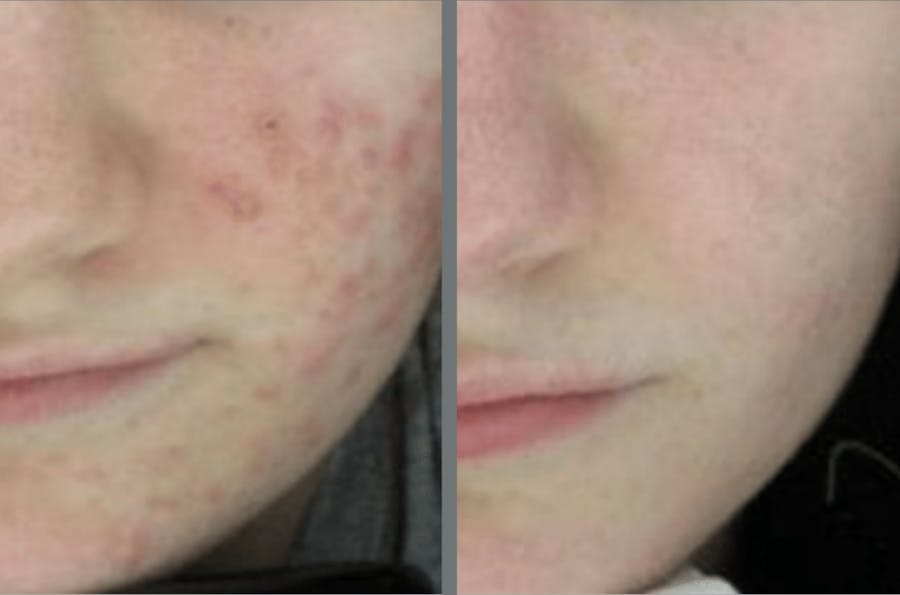 Laser Resurfacing Before & After Gallery - Patient 54187944 - Image 1