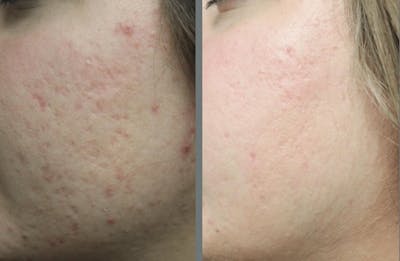 Laser Resurfacing Before & After Gallery - Patient 54187944 - Image 2