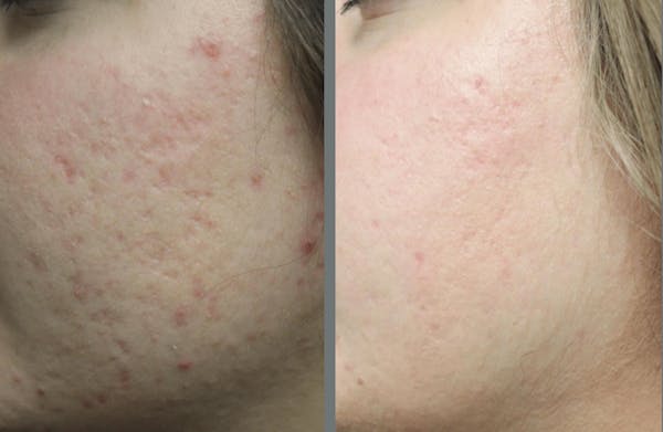 Laser Resurfacing Before & After Gallery - Patient 54187944 - Image 2