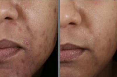 Laser Resurfacing Before & After Gallery - Patient 54187945 - Image 1