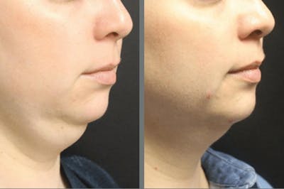 kybella before & after