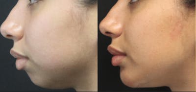 Chin Augmentation Before & After Gallery - Patient 54195608 - Image 1