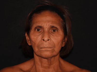 Facelift Before & After Gallery - Patient 101409974 - Image 1