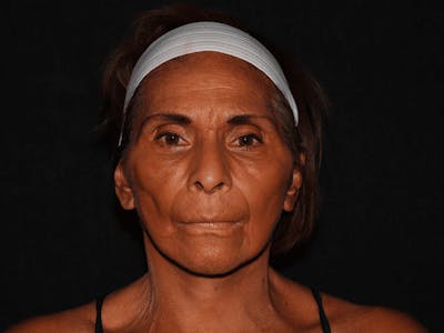 Facelift Before & After Gallery - Patient 101409974 - Image 2