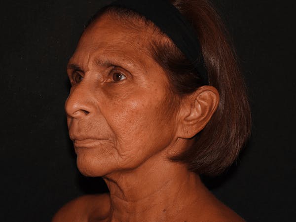 Facelift Before & After Gallery - Patient 101409974 - Image 3