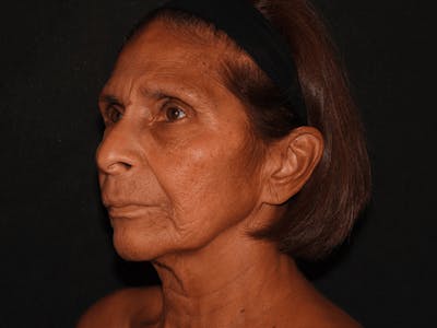 Facelift Before & After Gallery - Patient 101409974 - Image 3
