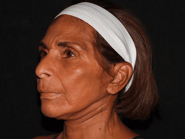 Facelift Before & After Gallery - Patient 101409974 - Image 4