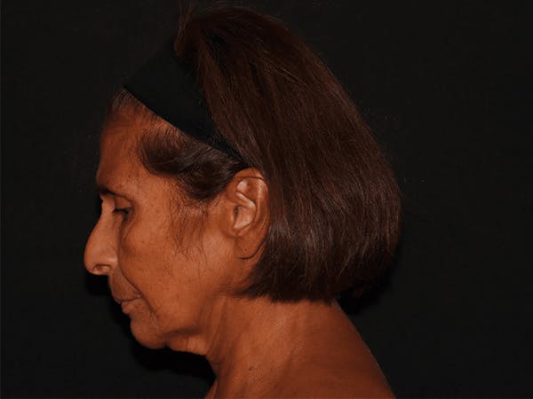 Facelift Before & After Gallery - Patient 101409974 - Image 5