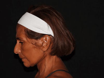 Facelift Before & After Gallery - Patient 101409974 - Image 6