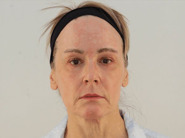 Facelift Before & After Gallery - Patient 101410085 - Image 1