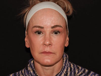 Facelift Before & After Gallery - Patient 101410085 - Image 2