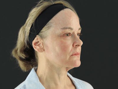 Facelift Before & After Gallery - Patient 101410085 - Image 3