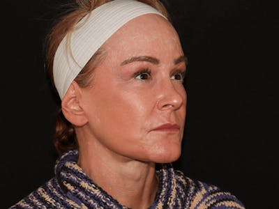 Facelift Before & After Gallery - Patient 101410085 - Image 4