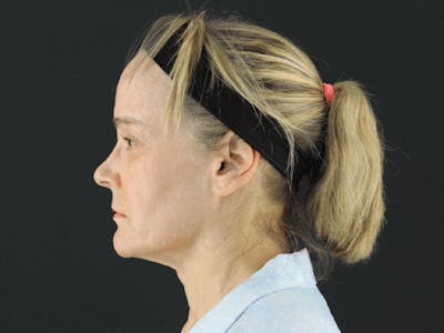 Facelift Before & After Gallery - Patient 101410085 - Image 5