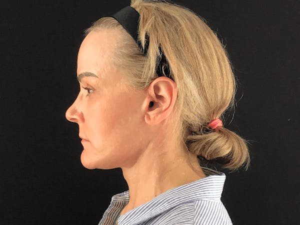 Facelift Before & After Gallery - Patient 101410085 - Image 6