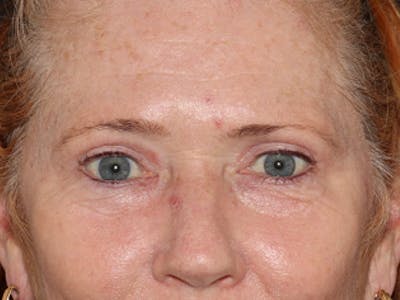  Blepharoplasty Before & After Gallery - Patient 101410175 - Image 1