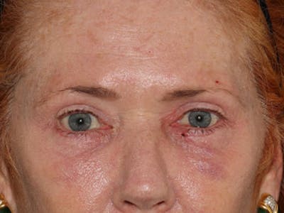  Blepharoplasty Before & After Gallery - Patient 101410175 - Image 2