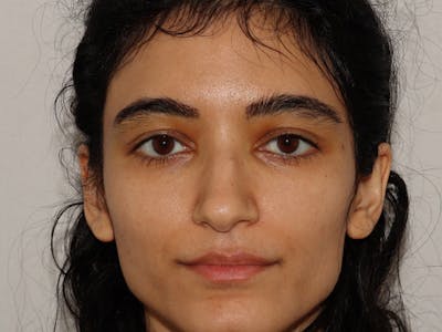 Hair Transplant Before & After Gallery - Patient 101410287 - Image 2
