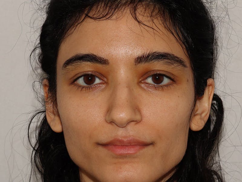 Hair Transplant Before & After Gallery - Patient 101410287 - Image 2
