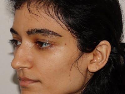 Hair Transplant Before & After Gallery - Patient 101410287 - Image 4