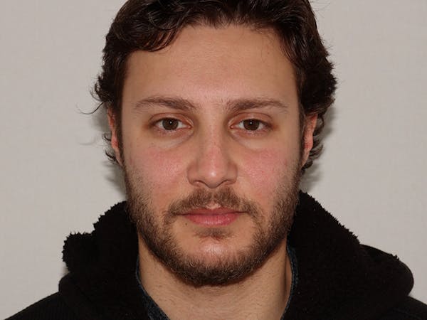 Hair Transplant Before & After Gallery - Patient 101410288 - Image 1