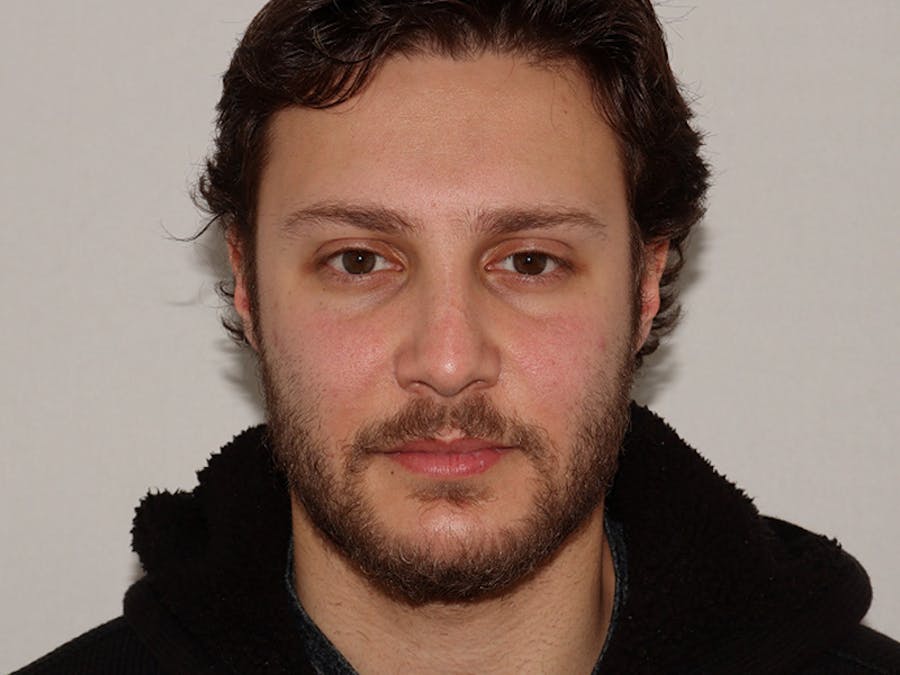 Hair Transplant Before & After Gallery - Patient 101410288 - Image 1