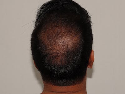Hair Transplant Before & After Gallery - Patient 101410289 - Image 1