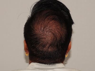 Hair Transplant Before & After Gallery - Patient 101410289 - Image 2