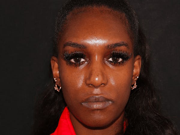 Lip Filler Before & After Gallery - Patient 141186443 - Image 2