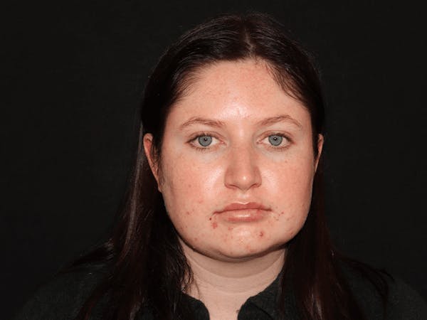 Lip Filler Before & After Gallery - Patient 141186434 - Image 2