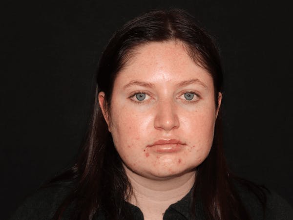 Injectables Gallery - Patient 101410581 - Image 2